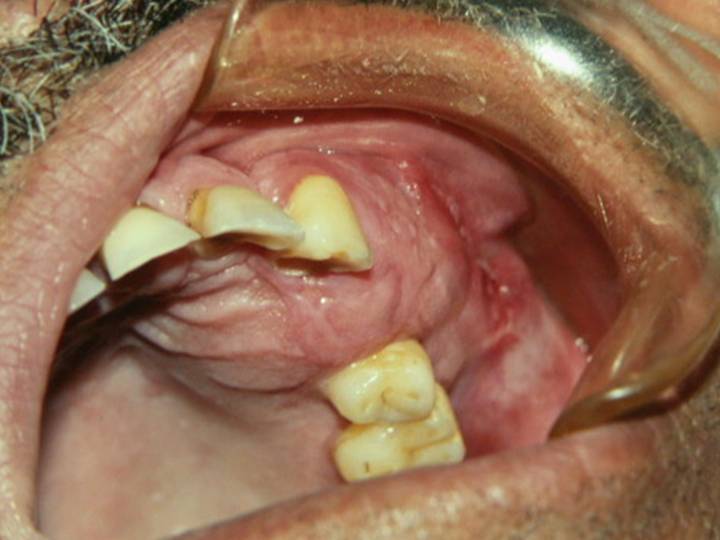 Carcinoma odontognico de celulas claras