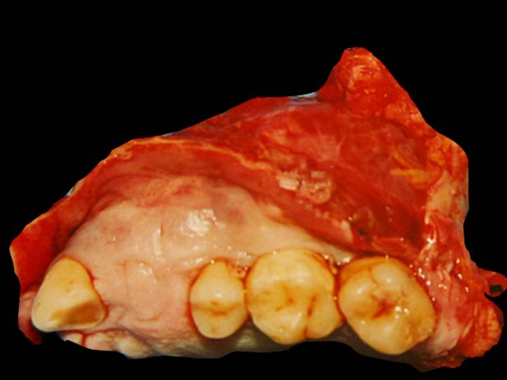 Carcinoma odontognico de celulas claras