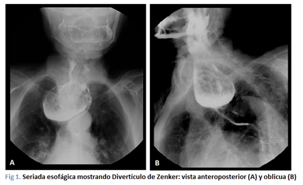 Divertículo de zenker dieta